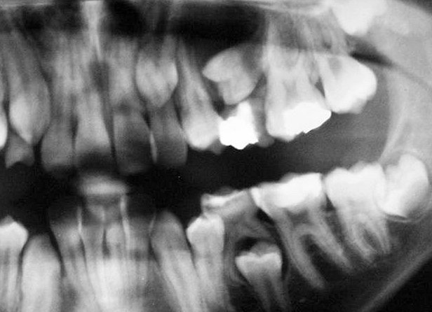 Aot Radiograph Adenomatoid Odontogenic Tumor Radiography