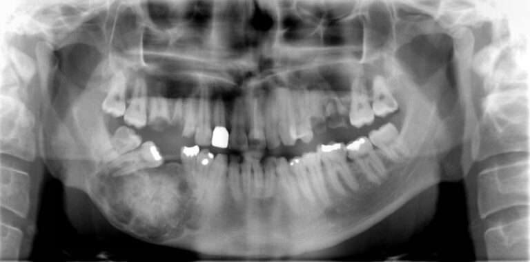 cemento-ossifying-fibroma-2nd-stage-ddmfr
