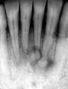 Periapical Cemento-Osseous Dysplasia 2nd stage - DDMFR