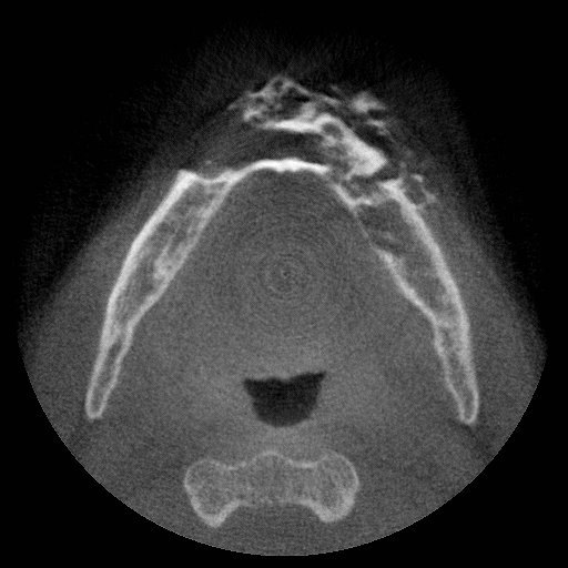 Calcifying Epithelial Odontogenic Tumour