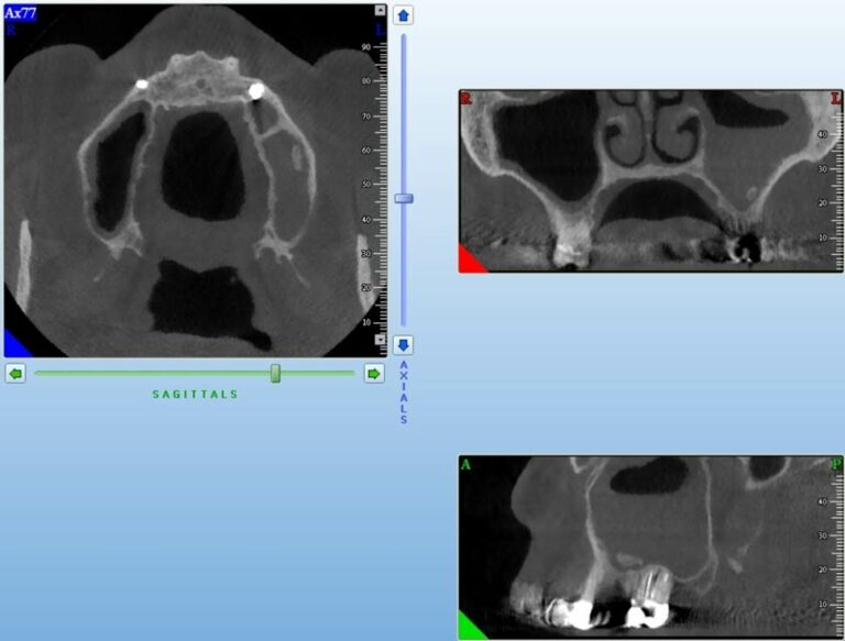 Foreign bodies in the sinus - DDMFR